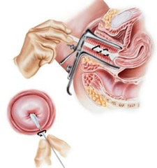 Krebsabstrich (PAP-Test) (© Medical Art Inc - istockphoto.com)